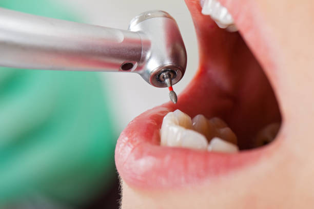 Best Emergency Wisdom Teeth Removal in Yukon, OK